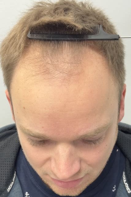 Haartransplantatie Behandeling Voor Dunner Wordend Haar