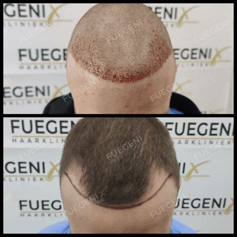 Haartransplantatie DHI: De Meest Geavanceerde Techniek