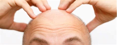 Haartransplantatie DHI: Is Het De Juiste Keuze Voor Jou?