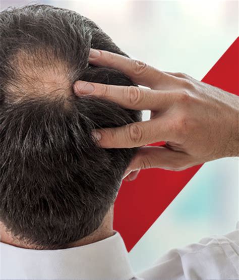 Haartransplantatie Mythen Ontkracht: Wat Is Waar?