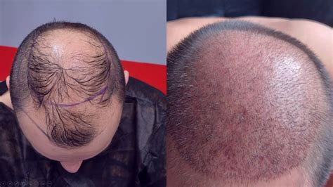 Haartransplantatie PRP: Herstel Van Haarverlies Met Bloedplaatjes