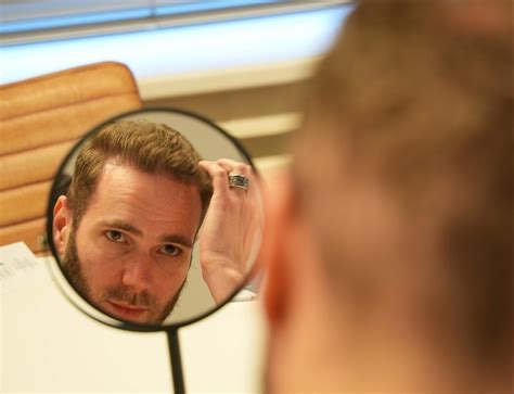 Haartransplantatie Saffier FUE: Waarom Het Populair Is
