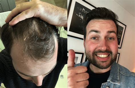 Haartransplantatie Voor Mannen: Wat Je Moet Weten