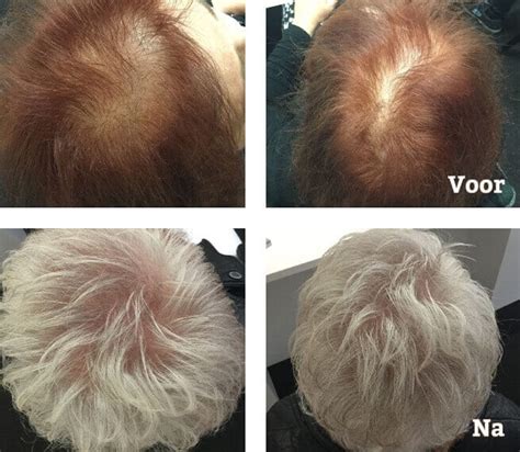 Vrouwen En Haartransplantatie: De Stijgend Interesse