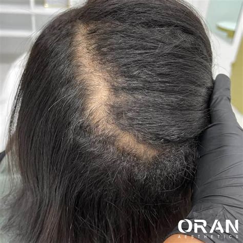 XL Hair: Een Innovatieve Oplossing Voor Haarverlies